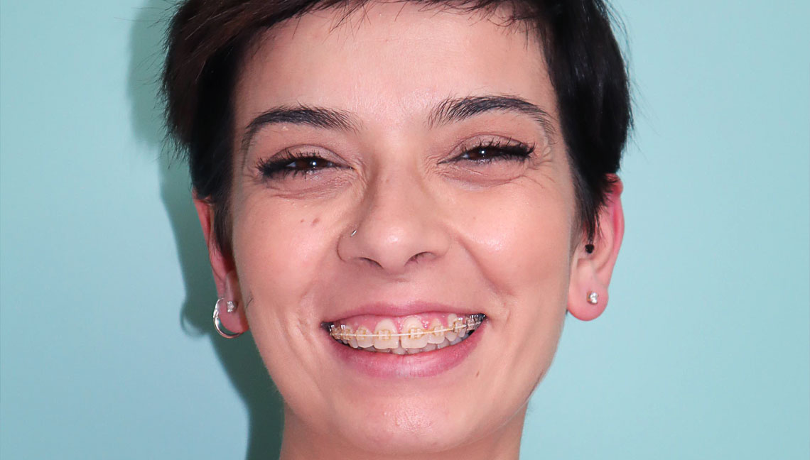 Ortodonzia fine crescita